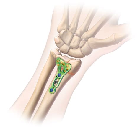 Collection – Distal Radius Open Reduction Internal Fixation | Singapore ...