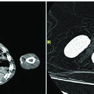 Chest CT showed bilateral hyperdense centrilobular nodules with... | Download Scientific Diagram