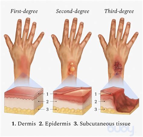 3rd Degree Burns Healed