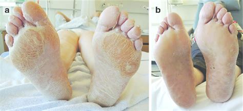 Laminar plantar hyperkeratosis on both feet with enhancement of areas... | Download Scientific ...