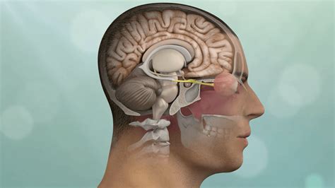 Brain & Skull Base Tumors | Pacific Brain Tumor Center