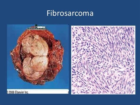 Soft tissue tumor