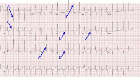 ECG from a patient with pulmonary hypertension demonstrating evidence... | Download Scientific ...