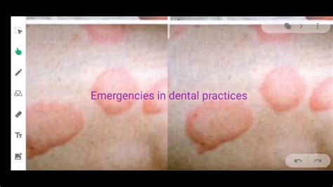 Allergic reaction (emergencies in dental practices part 2) - YouTube