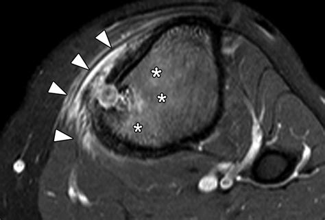 Radiologic Diagnosis of Osteoid Osteoma: From Simple to Challenging Findings | RadioGraphics