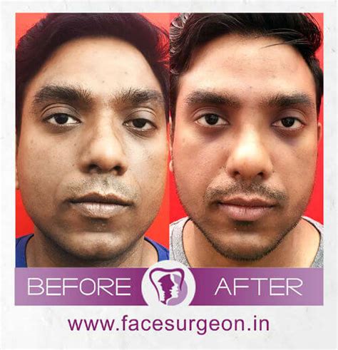 How Nose Surgery in India Is Performed Based on Ethnicity – Richardson's Plastic Surgery Hospitals