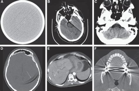 Beam Hardening Artifact Ct Brain - The Best Picture Of Beam