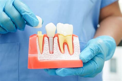 What Procedures Does an Endodontist Perform - Kentucky Endo