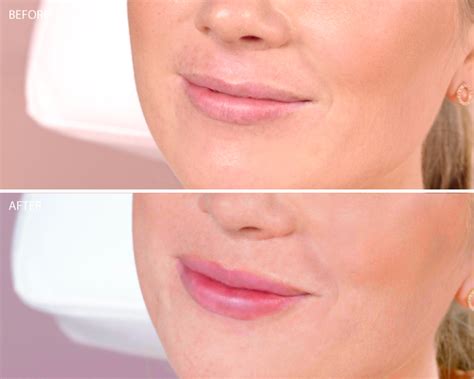 Restylane® Kysse - Lip Filler Irvine | Concierge Aesthetics, Orange County