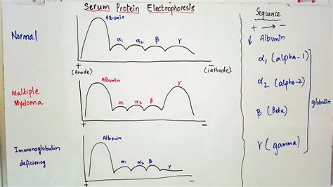 Serum Protein Electrophoresis importance and result interpretation in an easy way - YouTube