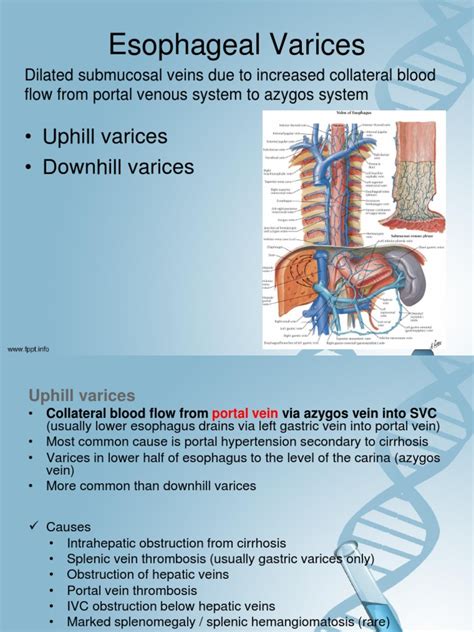 Esophageal Varices