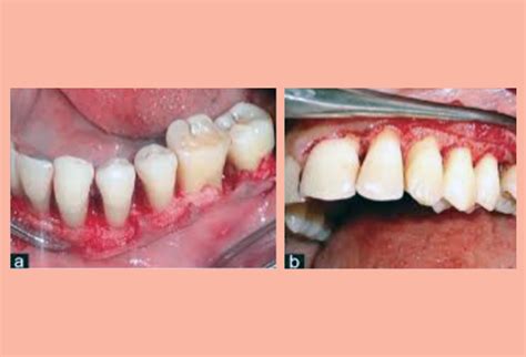 Flap Surgery (Gum Treatment) – Moses