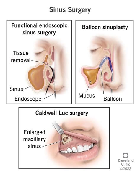 What Is A Nasal Endoscopy Procedure? (Indications, Side Effect Uses) | vlr.eng.br