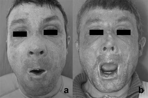 Treatment of microstomia with commissuroplasties and semidynamic acrylic splints - Oral Surgery ...