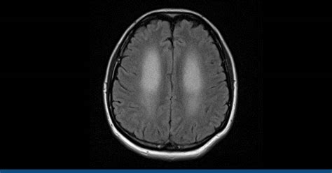 Hashimoto's Encephalopathy (He): Diagnosis, Symptoms, And More