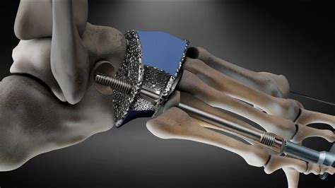 Charcot Foot Implant surgery 3D animation - YouTube