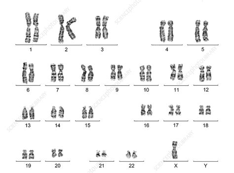 Human karyotype with Turner syndrome - Stock Image - C016/6740 - Science Photo Library