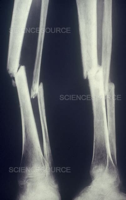 Broken Leg X-Ray | Stock Image - Science Source Images