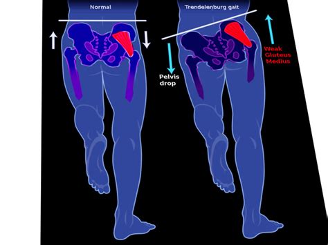 [Figure, Trendelenburg Gait. The left image shows a normal gait. The ...