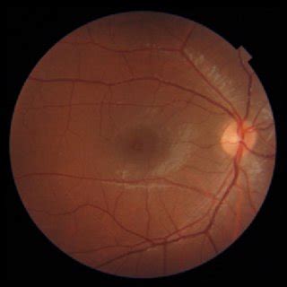 Normal fundoscopy. Pink optic disc with sharp margins, normal vessels... | Download Scientific ...