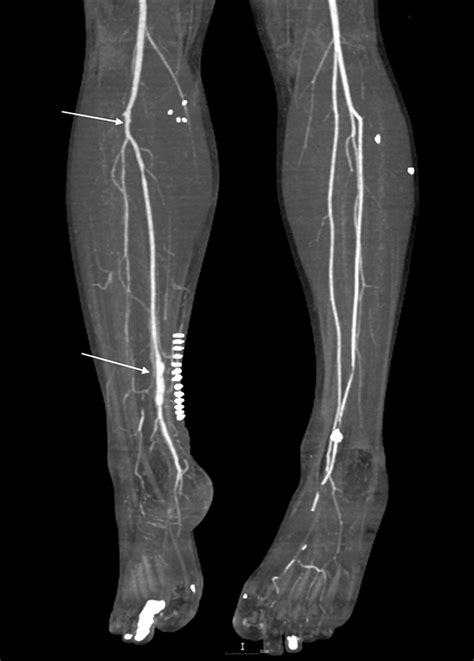 Posterior Tibial Artery Angiogram