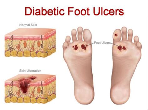 Chronic Diabetic Foot Ulcers – Jewish Chicken Ranchers