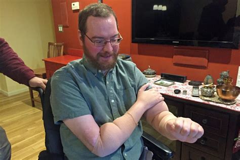 2 Years After Double Arm Transplant, Boston Man Is Thriving | Here & Now