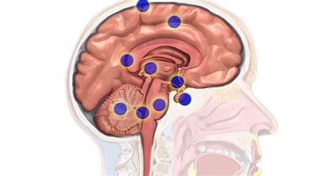 Thalamic stroke Left, Right, Prognosis, Treatment - Health Care Tips ...