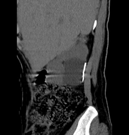 Renal milk of calcium cyst | Image | Radiopaedia.org