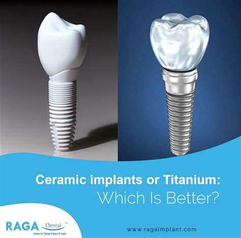 Titanium implants have been dominating implant dentistry since its arrival. Titanium is highly ...