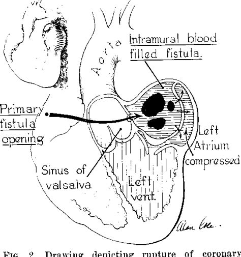 Sinus Of Valsalva Location