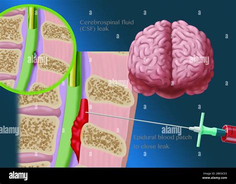 Epidural Blood Patch Procedure, Illustration Stock Photo - Alamy