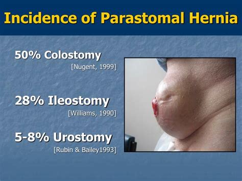 PPT - Parastomal Hernia Repair PowerPoint Presentation - ID:790450