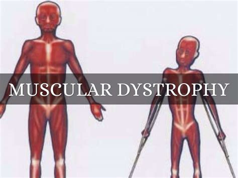 Muscular Dystrophy: 10 Muscular Dystrophy Symptoms