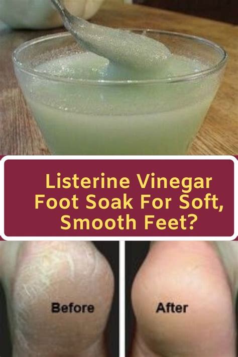 Listerine Vinegar Foot Soak For Soft, Smooth Feet? - Diet Sehat