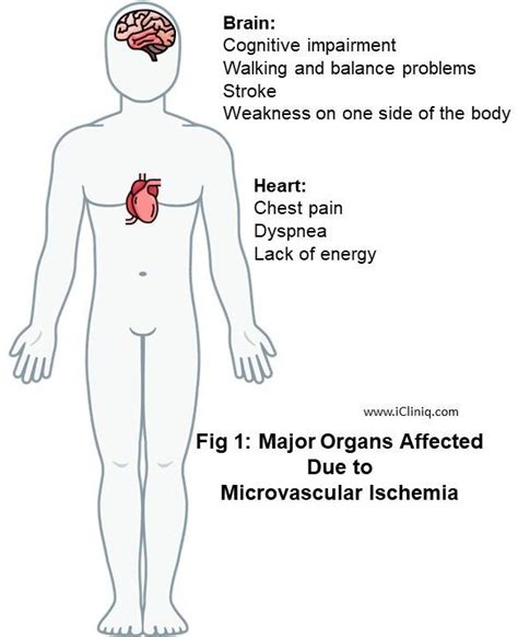 Microvascular Ischemic Disease - Symptoms | Causes | Diagnosis ...