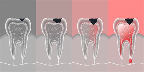 Cavities In Back Teeth