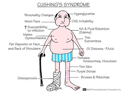 siadh vs cushing's - Google Search | Cushings syndrome, Nursing school prerequisites, Nursing ...