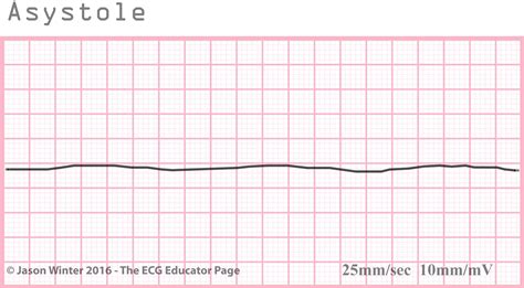 ECG Educator Blog : Asystole