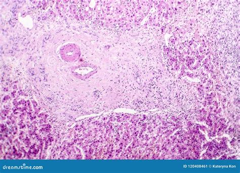 Histopathology Of Liver Abscess Royalty-Free Stock Image ...