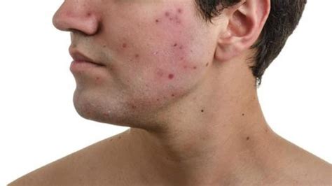 Acne in men: Causes, treatment, and home remedies