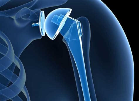 Shoulder Joint Replacement Myths and Facts - docOPD