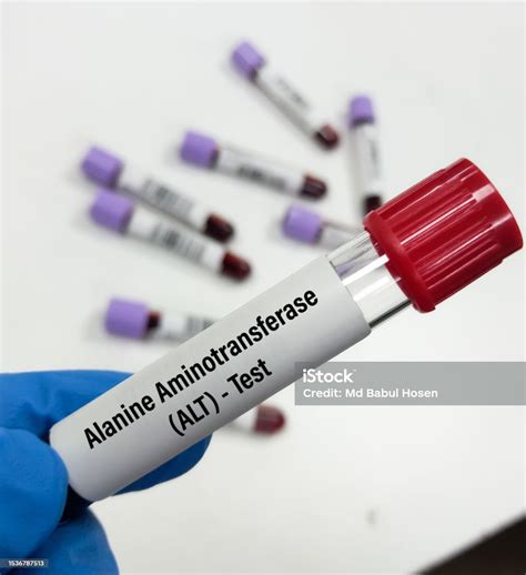 Blood Sample For Alanine Transaminase Or Sgpt Test Liver Function Test ...