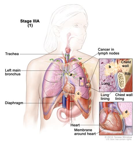 [Table], Table 8. Definitions of TNM Stage IIIAa - PDQ Cancer ...