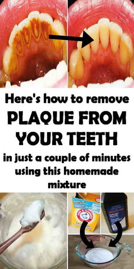 Remove Plaque From Your Teeth With This Homemade Mixture. #teethcleaning #diy | Teeth tartar ...