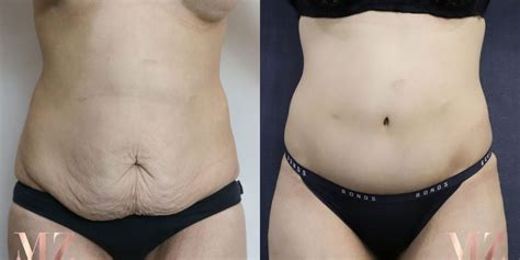 Abdominoplasty Sydney • Dr Zacharia