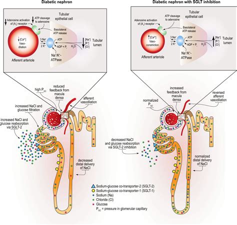 SGLT2 Inhibitors and Adverse Events: A Closer Look – AJKD Blog