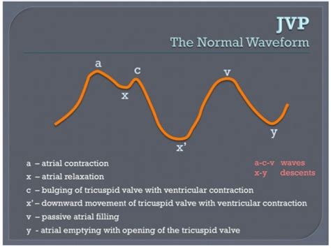 A And V Wave Of Jvp - Shajara