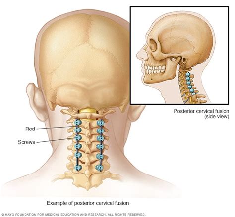 Fusion from back of neck - Mayo Clinic