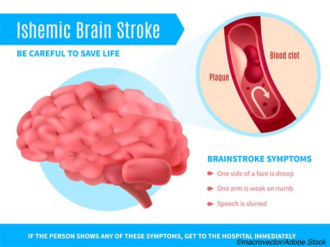 OCD—A Risk Factor for Ischemic Stroke? - Physician's Weekly